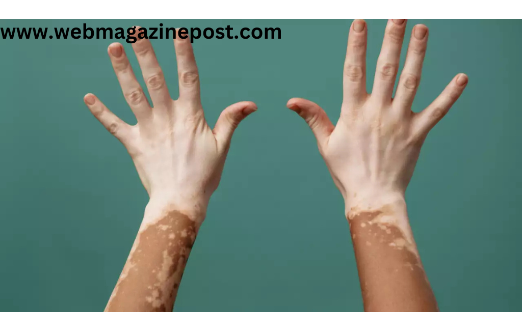 Vitiligo